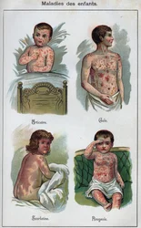 Doenças de crianças: Urticária, sarampo, sarna, escarlatina. In" The new natural medication" de F.E. Bilz.