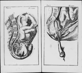 Nascimento de um bebê com uso de fórceps Placa de "Uma abreviação da prática de obstetrícia" por William Smellie (1697-1763)