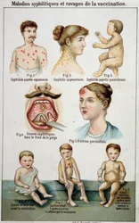 Prancha que ilustra as diferentes formas de doenças sifilíticas e os perigos da vacinação - na medicina natural de Bilz, final do século XIX.