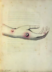 Pústula de varíola bovina no braço de Sarah Nelmes, de "Um Inquérito sobre as Causas e Efeitos das Variolae Vaccinae" de Edward Jenner (1749-1823) gravado por Pearce, c.1800
